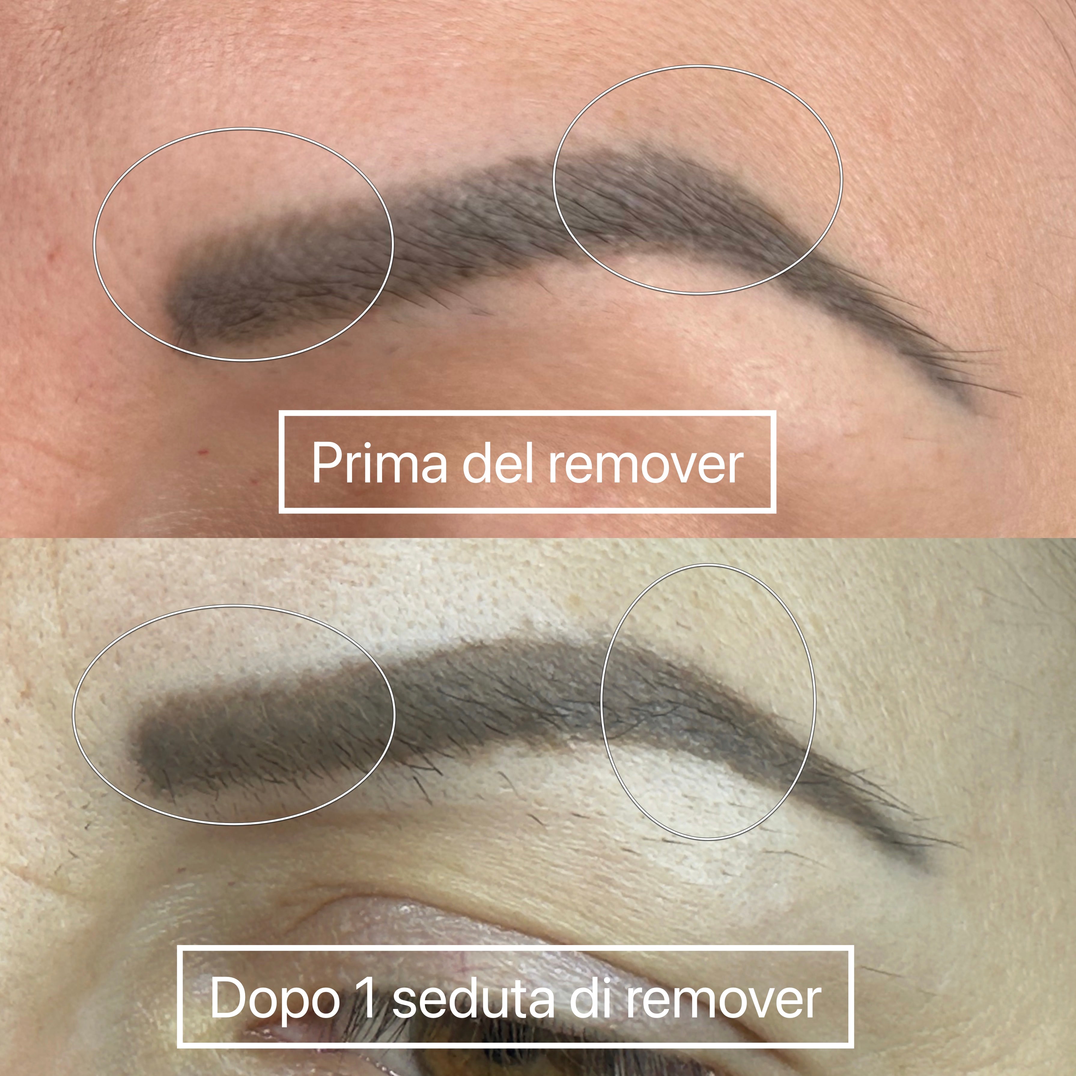 Corso Remover Tatoo Online